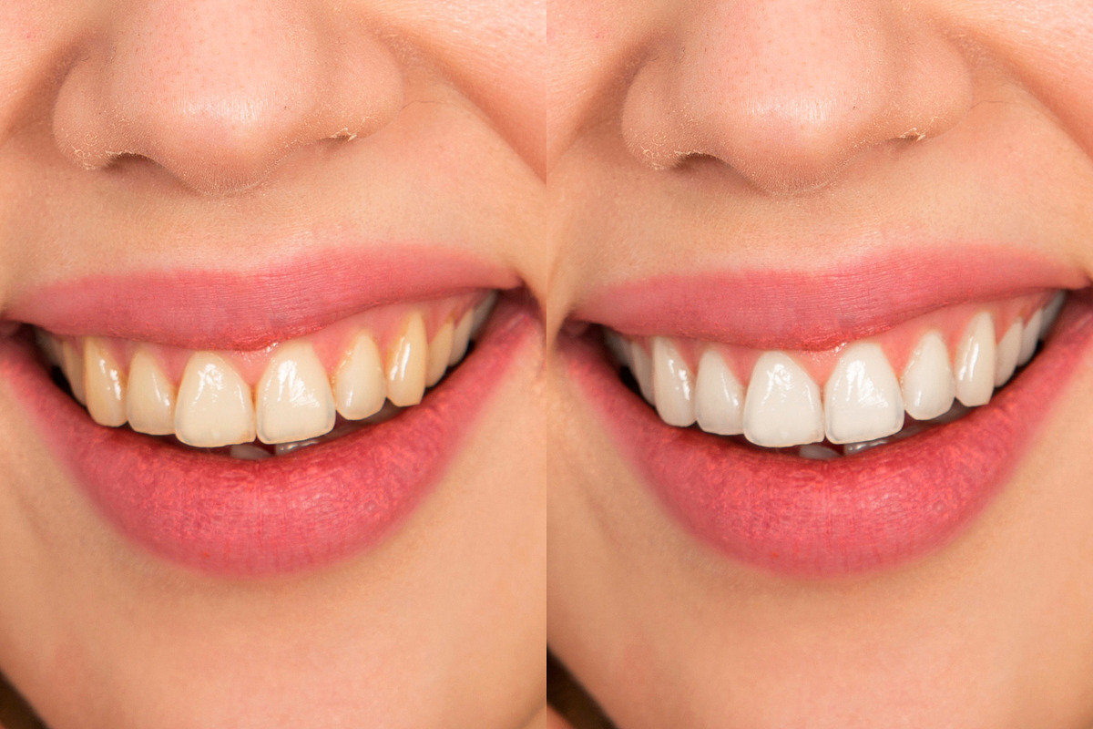 White Teeth Photoshop Action in Photoshop Actions - product preview 2