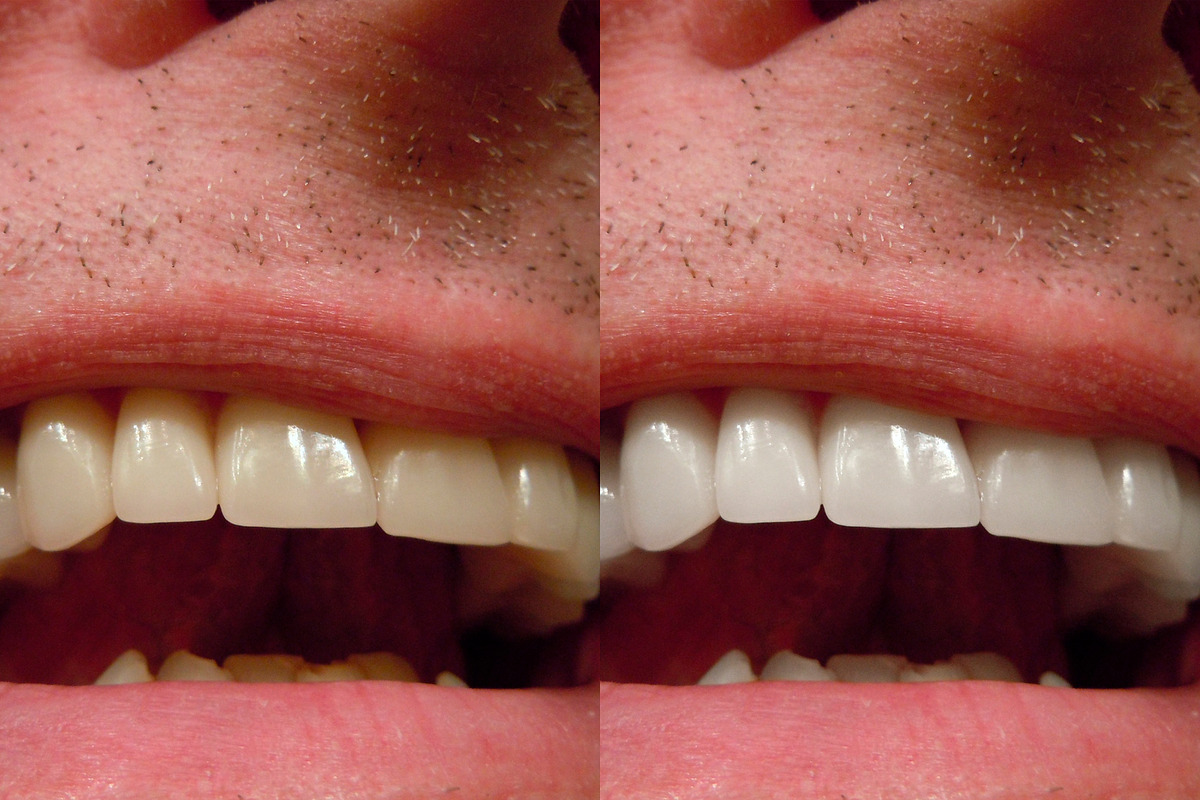 White Teeth Photoshop Action in Photoshop Actions - product preview 3